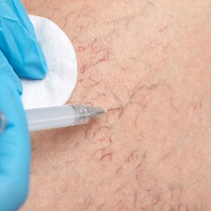 treatment-thumbnail-Sclerotherapy-300px